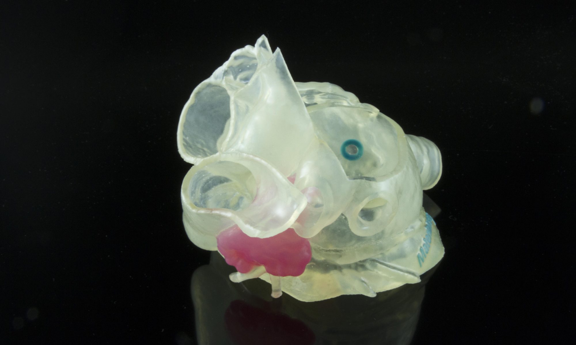 Model of patient's left atrial appendage (LAA) that allows surgeons to select the appropriate device and plan the optimal approach to occlude the LAA.
