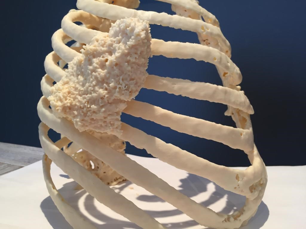 Patient-specific model of a tumor on the thoracic wall, 3D printed using the Stratasys Fortus 450mc (part 1).